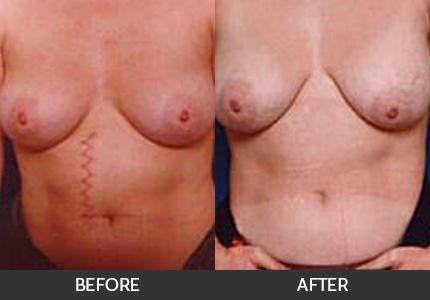 C-Section Revision Los Angeles  Beverly Hills C-Section Scar Removal